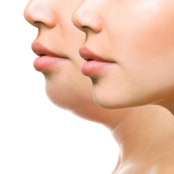 Brief Knowledge Kybella and CoolSculpting